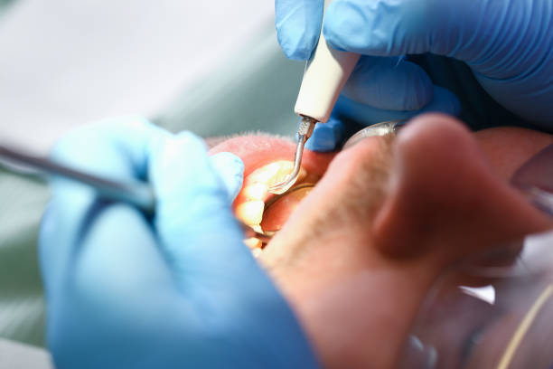 Best Dental Abscess Treatment in Oelwein, IA