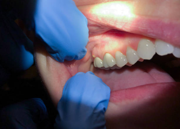 Best Emergency Wisdom Tooth Extraction in Oelwein, IA